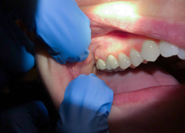 Best Emergency Treatment for Dental Infections or Abscesses in Camanche, IA