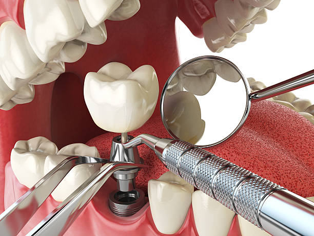 Best Emergency Dental Care for Broken or Chipped Teeth in Camanche, IA